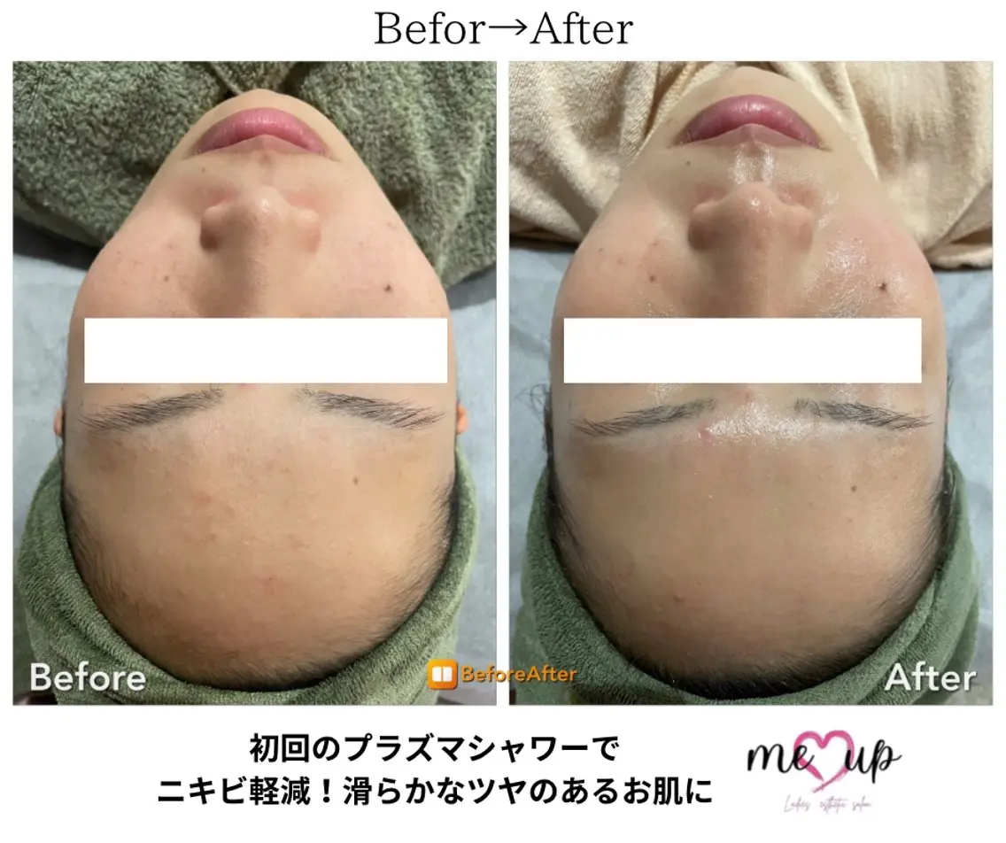 エステ Meupニキビ専門店 背中/ハーブ/肌管理のその他イメージ