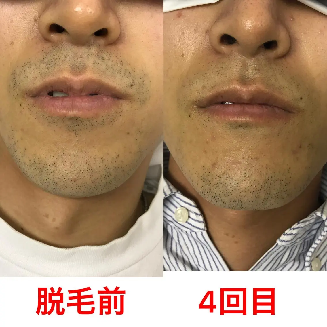 メンズ 脱毛 メンズ脱毛サロン /金山昌弘のエステ・リラクイメージ