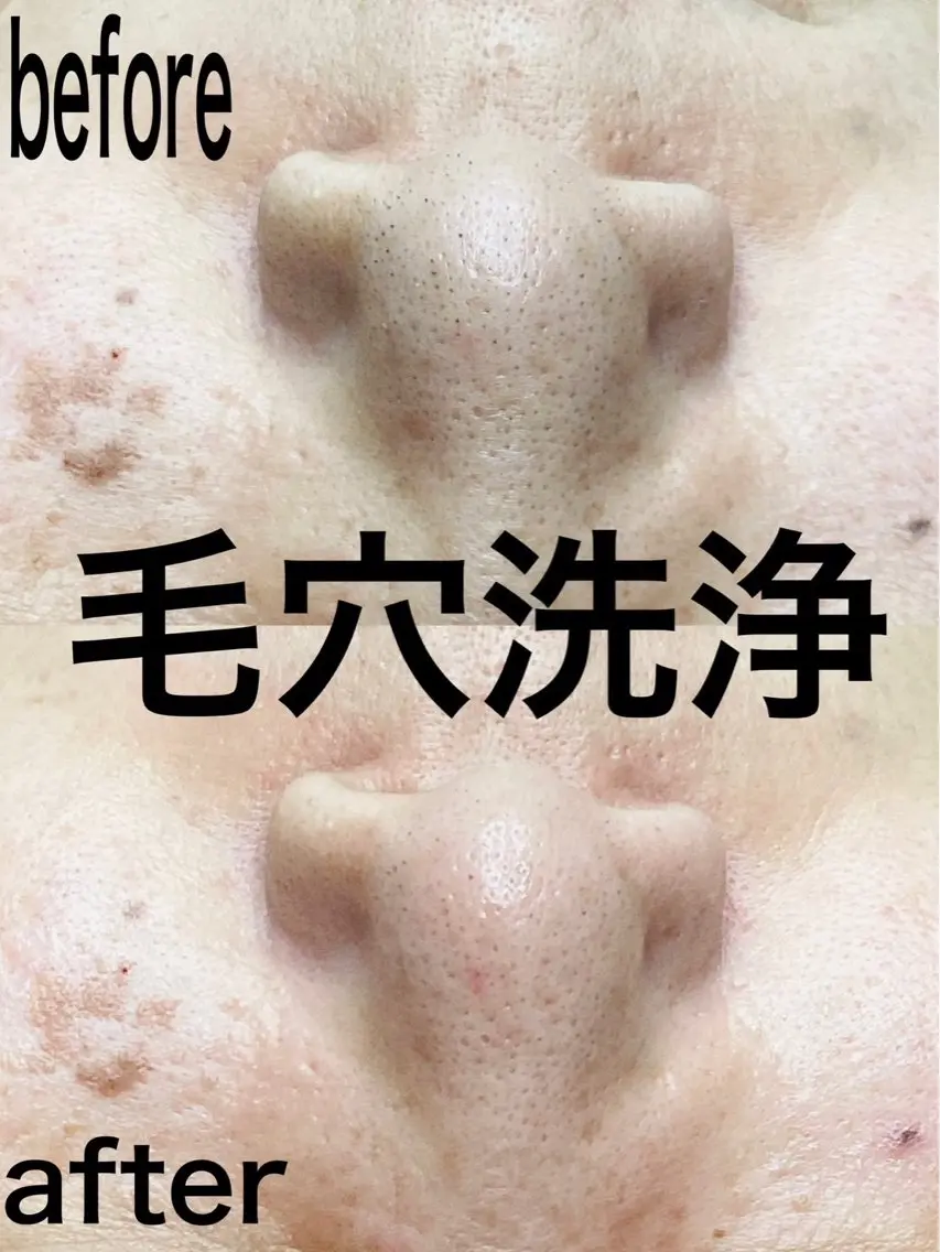 その他 最新美肌脱毛 韓国水光肌🫧のその他イメージ