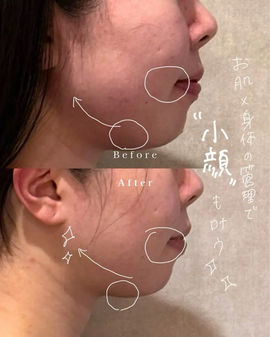 お試しメニュー🎀肌診断✖️肌管理エステ✖︎小顔リフトアップケアの写真
