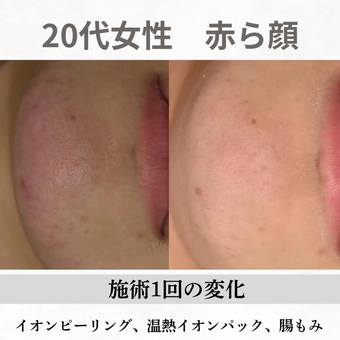 重度ニキビ専門🌷 ダウンタイムなしのエステ・リラクイメージ