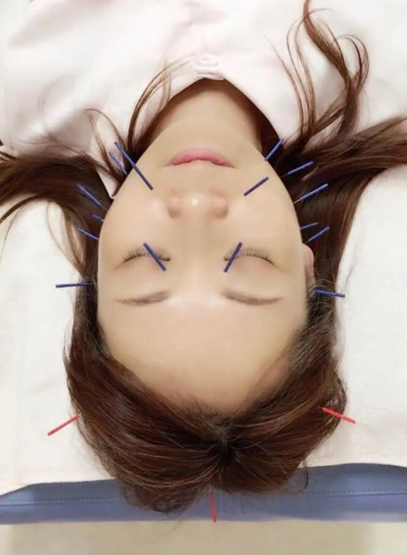 初回美容鍼クイックコース(お顔の美容鍼初回1000円OFF)の写真