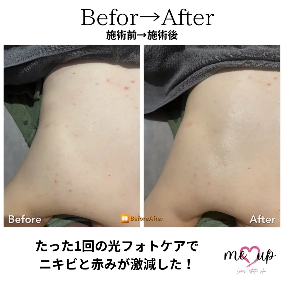 エステ Meupニキビ専門店 背中/ハーブ/肌管理のその他イメージ