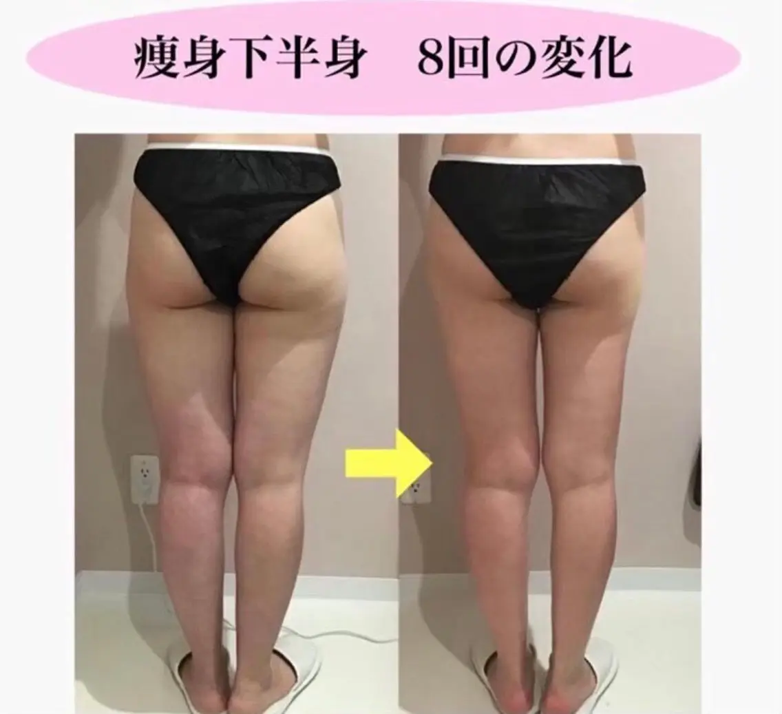 【痩身】【太もも･お尻 】ヒップアップ美尻を目指したい方🍑引き上げながらガッツリ施術🔥キャビ/ラジオ波/吸引/EMSの写真