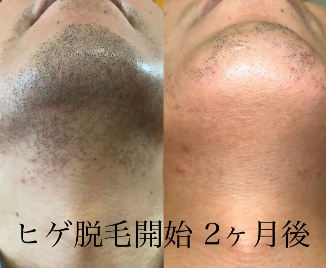(効果◎)顔+ヒゲ脱毛/メンズの写真