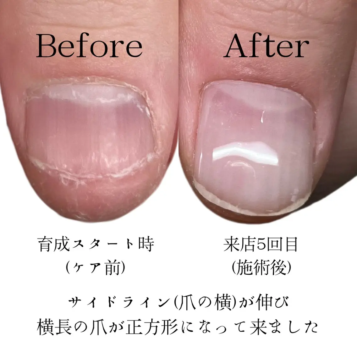 深爪・自爪育成。一回のみのご利用はご遠慮下さい。数ヶ月通っていただく事が条件になります。表記の価格は一回の施術料金です。の写真