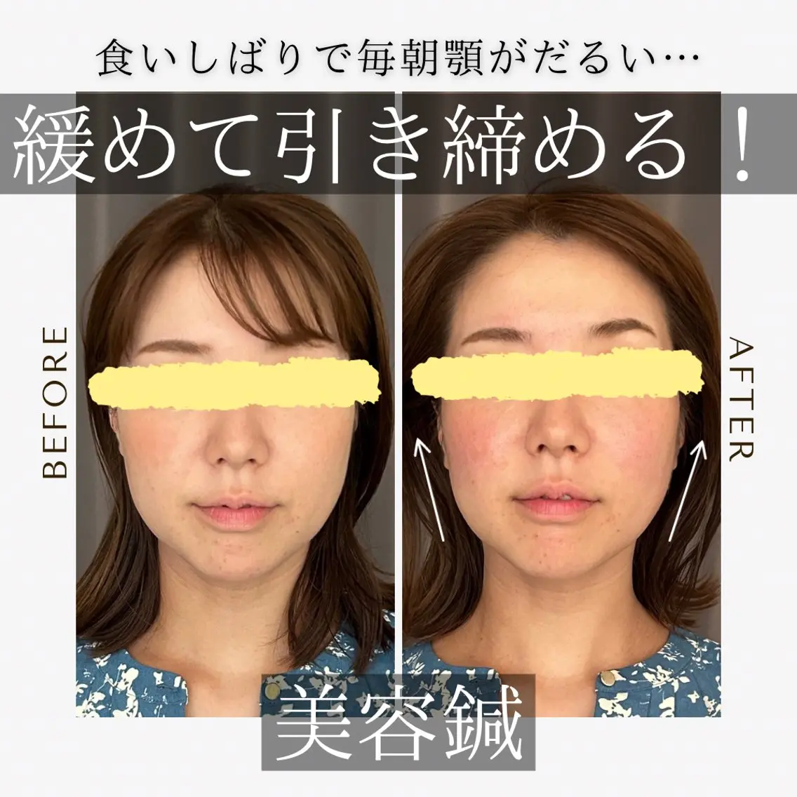 《美肌･小顔》美容鍼 ＆マッサージ＊MEIのエステ・リラクイメージ