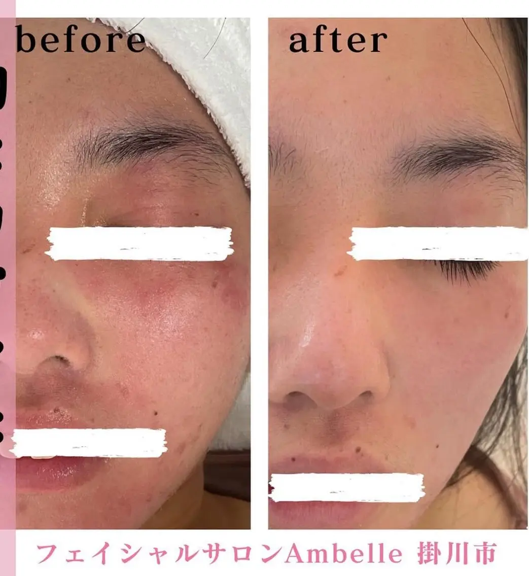 【アトピー肌】【赤み肌】【セラミドお肌に導入】特化コースの写真