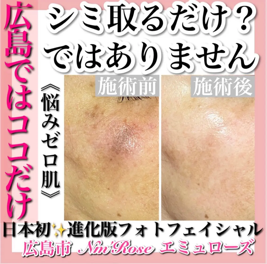 毛穴と光打ち放題の最強メニューの写真