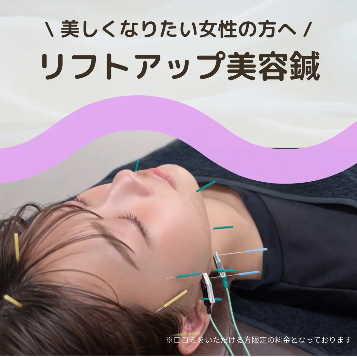 【美しくなりたい女性の方へ】リフトアップ美容鍼の写真