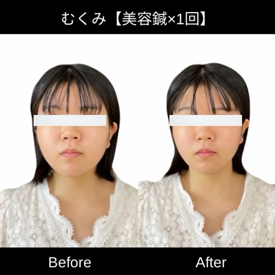 【U30限定】✨速攻小顔✨電気美容鍼の写真