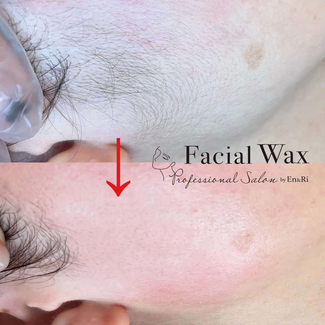 フェイシャルWAX脱毛 ※夏に溜まった皮脂、角質ごっそり！！の写真