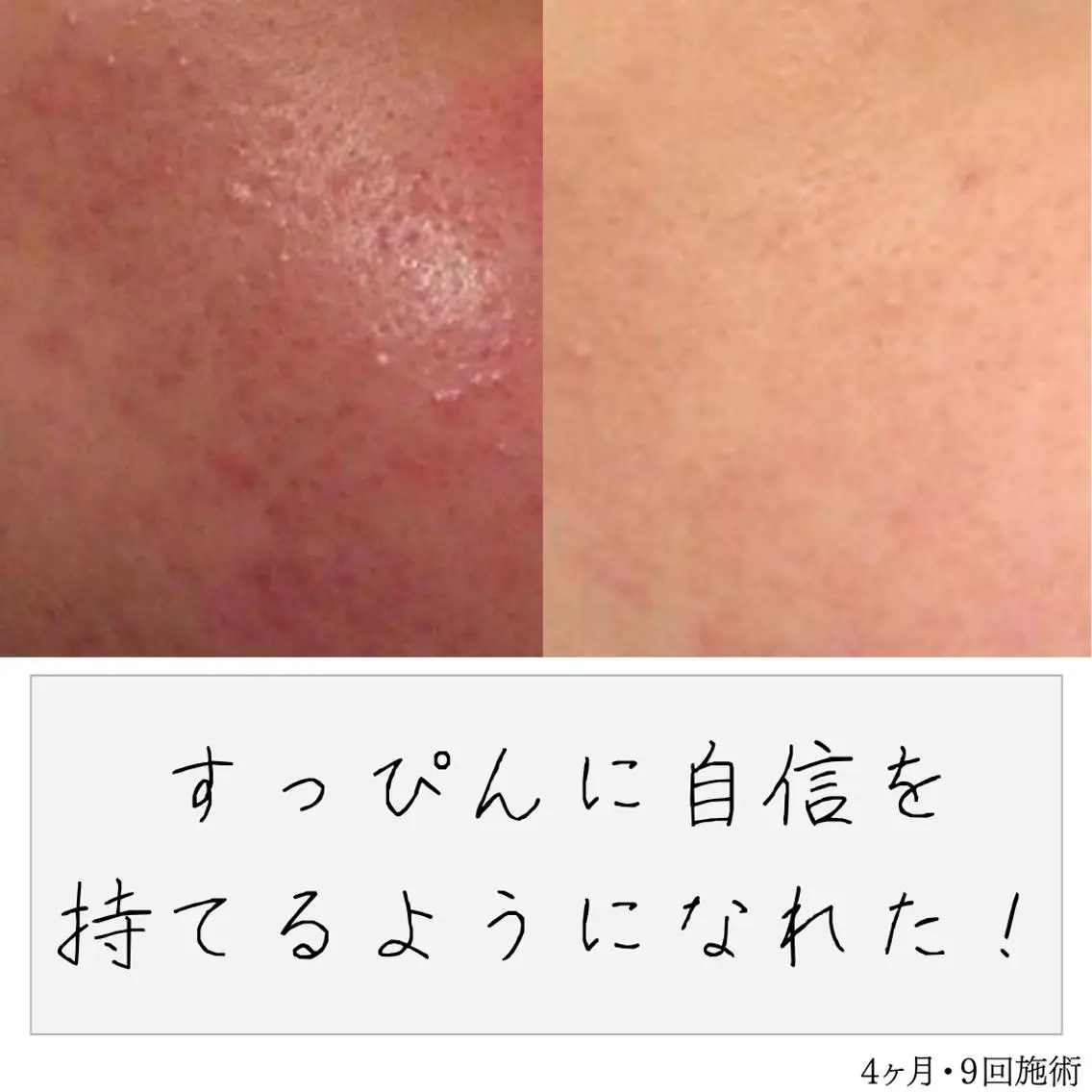 ニキビ経験者が施術 する専門サロン🌻のエステ・リラクイメージ