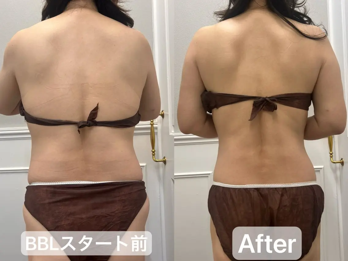 【BBL】光ボディートリートメント ウエスト集中コースの写真
