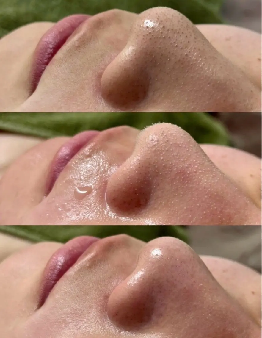 溶ける角栓【毛穴吸引】引き締めパック&鎮静パック付き👃🏻気になる鼻/顎/眉間の部分ケア¥4,980★の写真