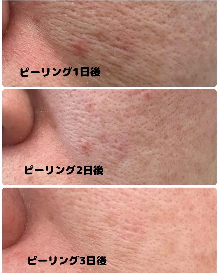 🧖♀️発光美艶ピーリング🧖♀️美白パック付の写真