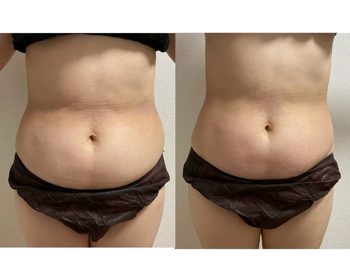 《痩身都度払い》美くびれ引き締めコースの写真