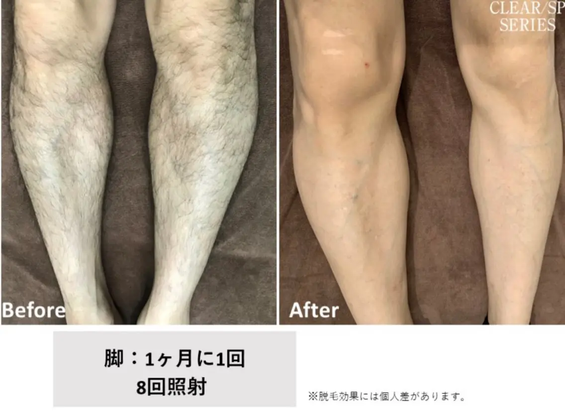 メンズ 脱毛 小川 縁のエステ・リラクイメージ