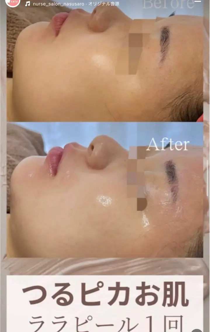 韓国式ピーリング+水光パック|うるおい肌管理の写真