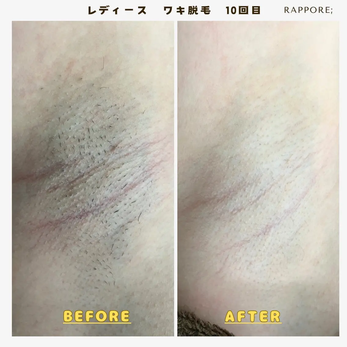 脱毛 Rappore; 心斎橋　みずきのエステ・リラクイメージ