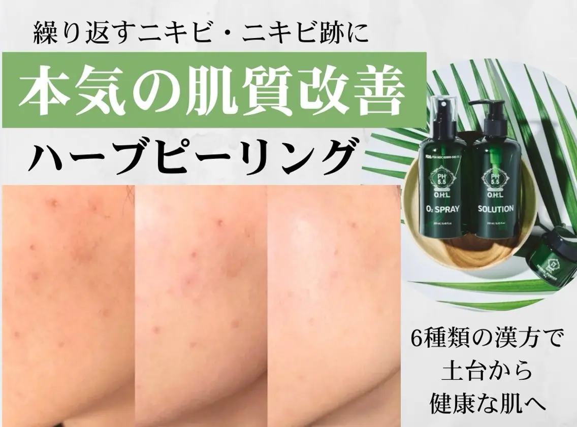 【ニキビ/繰り返す肌荒れ卒業!】剥離なしハーブピーリングの写真
