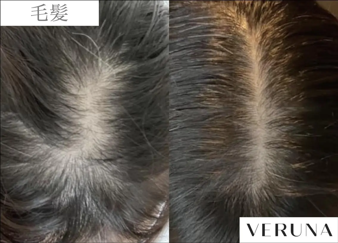 髪・頭皮の悩みにVERUNAスカルプ棘ケア(ご希望箇所へのスポット施術)+ドライヘッドスパ20分の写真
