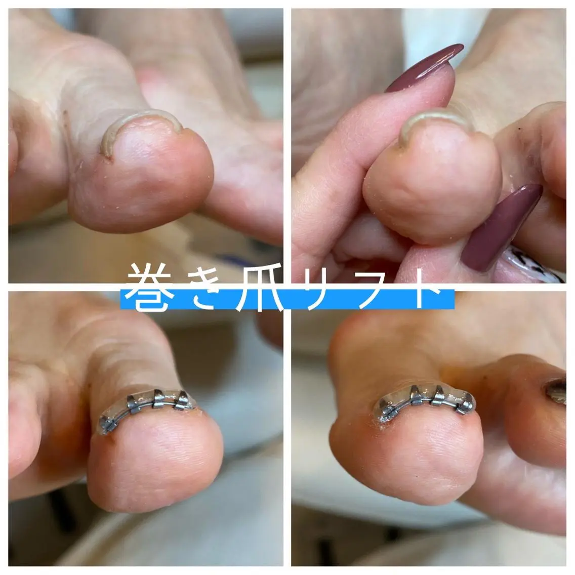 ネイル ♢ME2ROOM♢ #巻き爪#リラクのネイルデザイン
