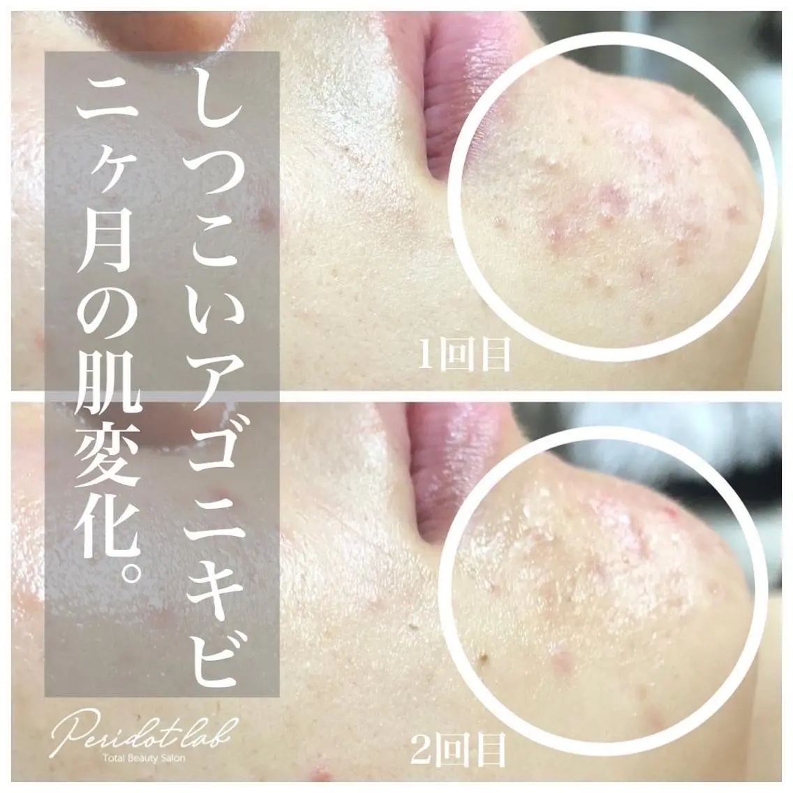 【初回限定価格✨】迷ったらコレ!/繰り返す肌荒れ/肩首コリ/敏感肌/むくみ/肌ｽﾄﾚｽ撃退フェイスリペルコース60minの写真