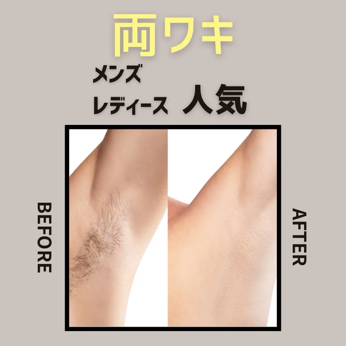 【自己処理だけは黒ずみの元!】 両ワキの写真