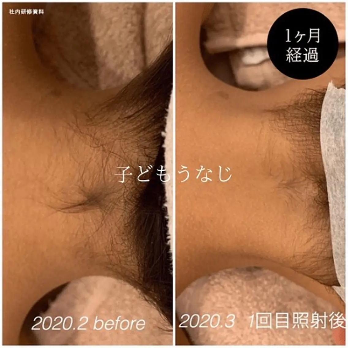 キッズ脱毛　全身　VIO + 顔の写真