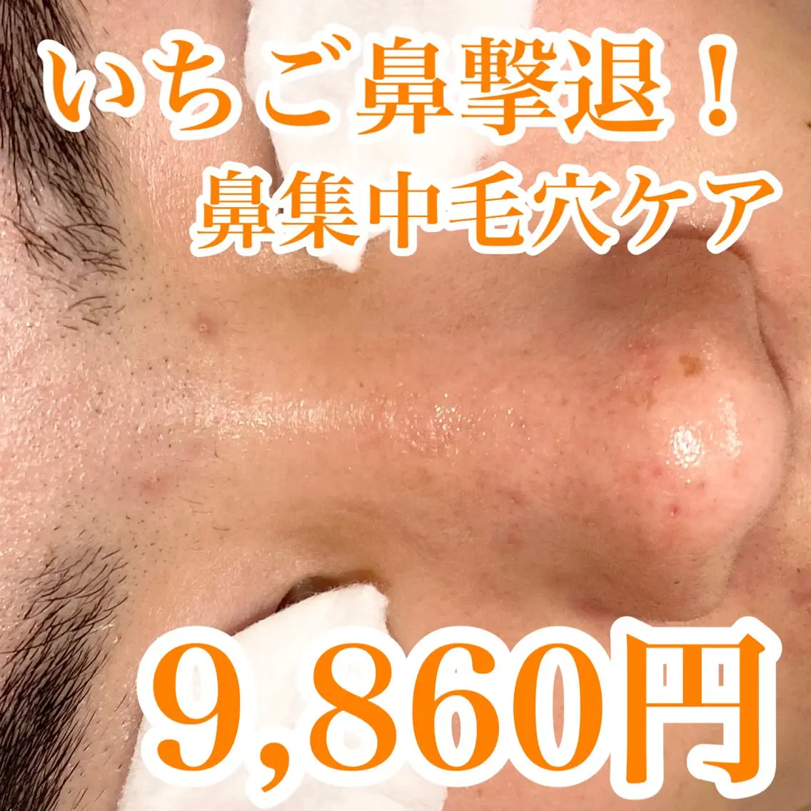 詰まり、黒ずみ毛穴に!毛穴エクストラクションの写真