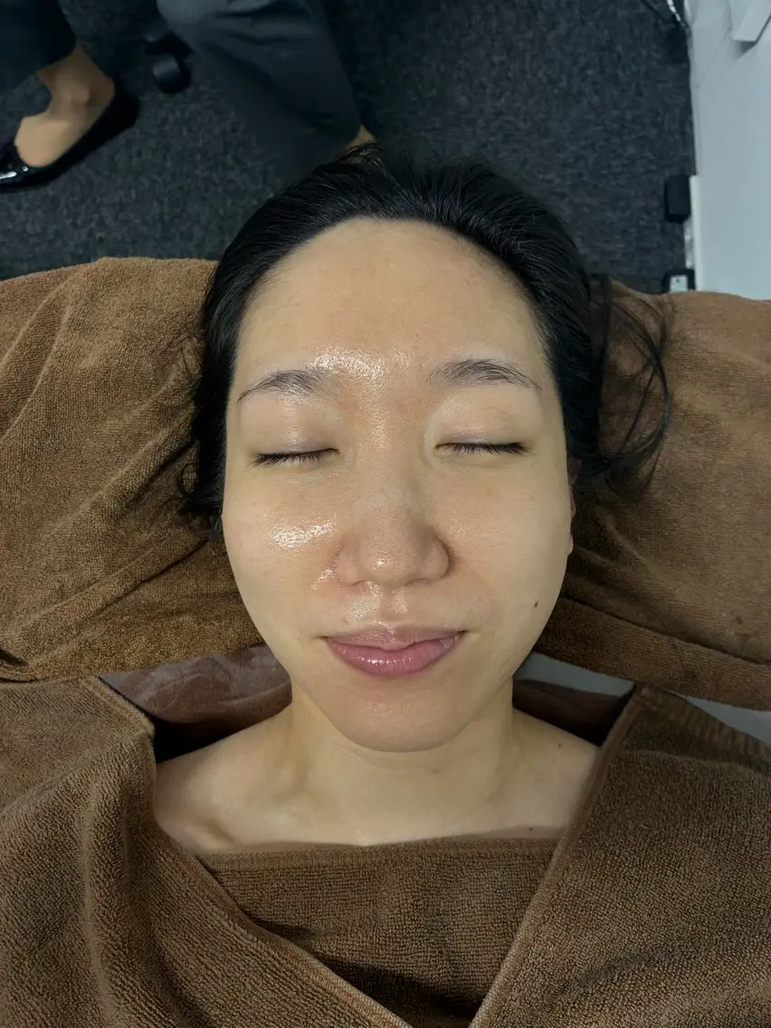 切らないたるみケア【ダーマコア】　Bio Boost➕フラクショナルＲＦの写真