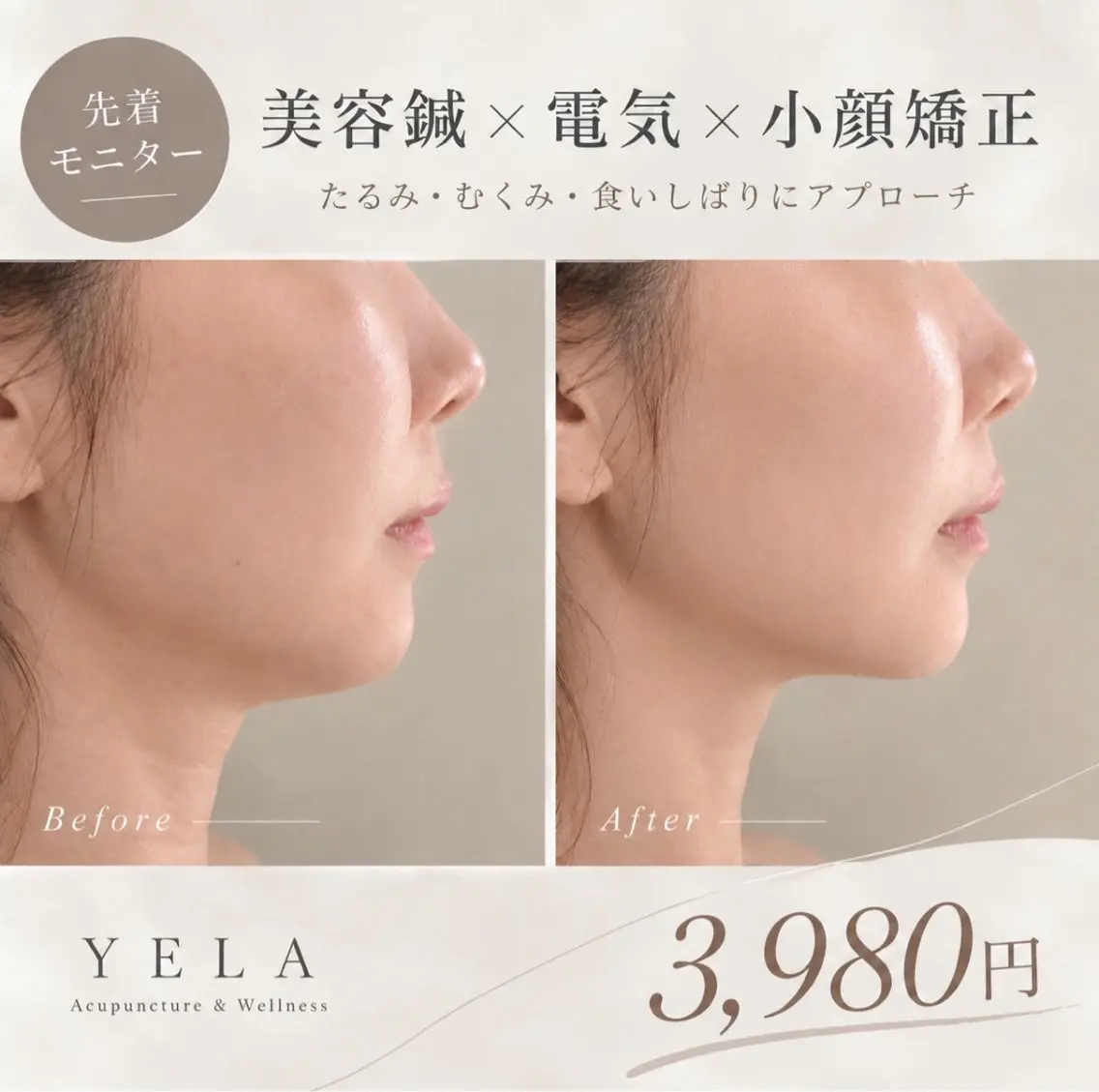【先着モニター】美容鍼×電気×小顔矯正 3,980円の写真