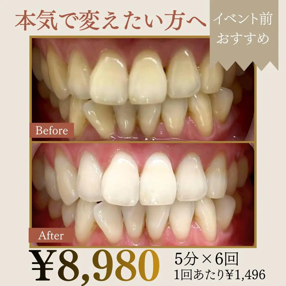 🔥【本気の集中ケア】5分照射×6回|ハイパワーセルフホワイトニング|通常¥29,700→初回¥8,980の写真
