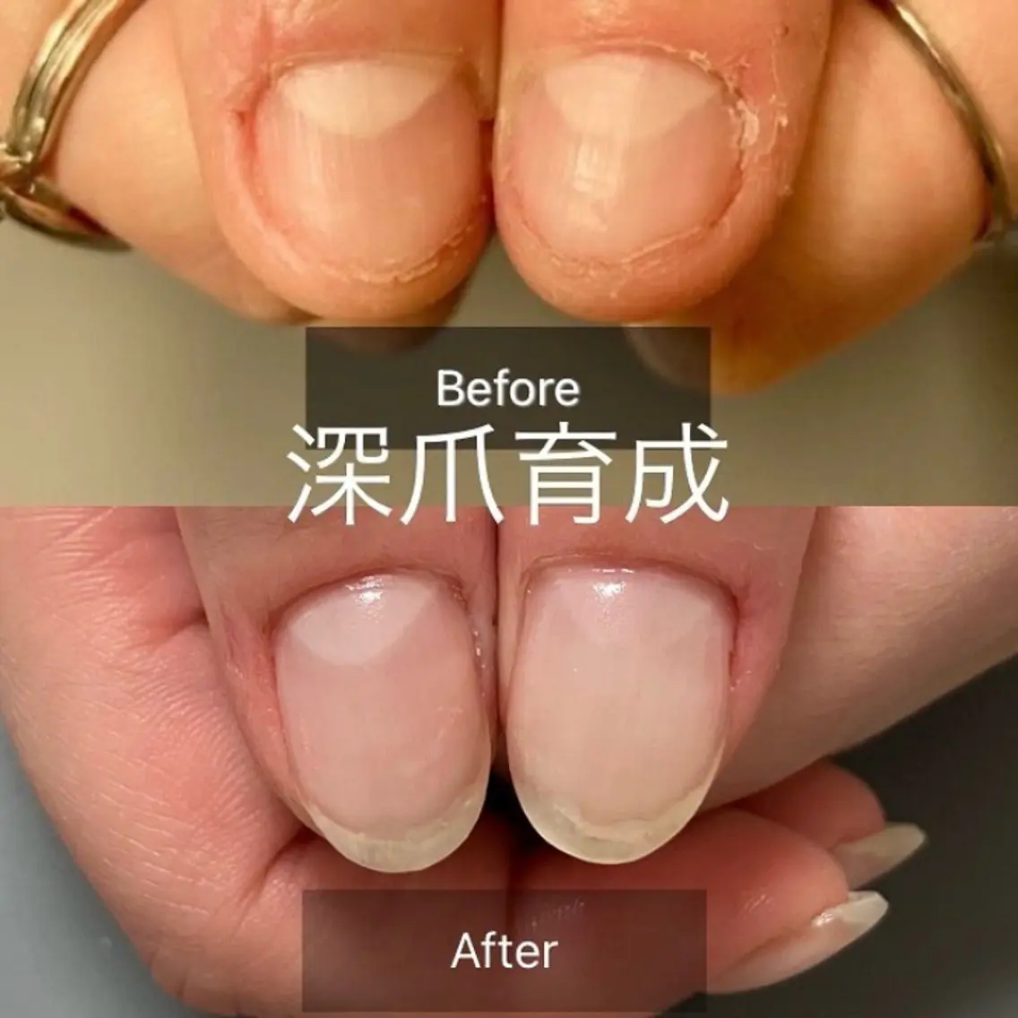 深爪育成コースの写真