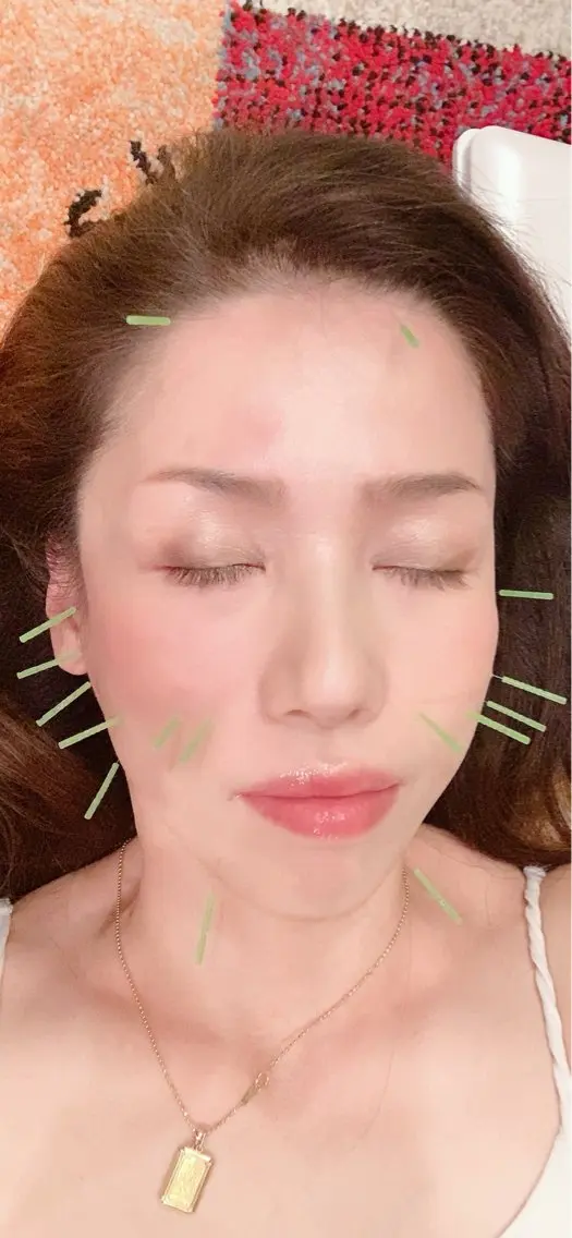 初めて美容鍼(お顔全体)16本の写真
