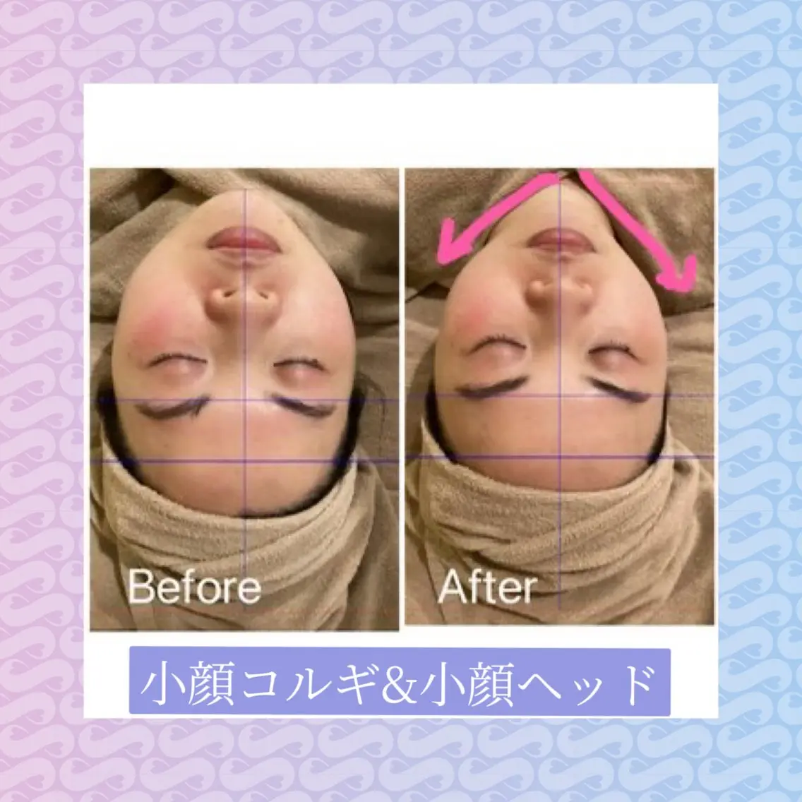 小顔フェイシャル（毛穴洗浄＆美白ケア）の写真