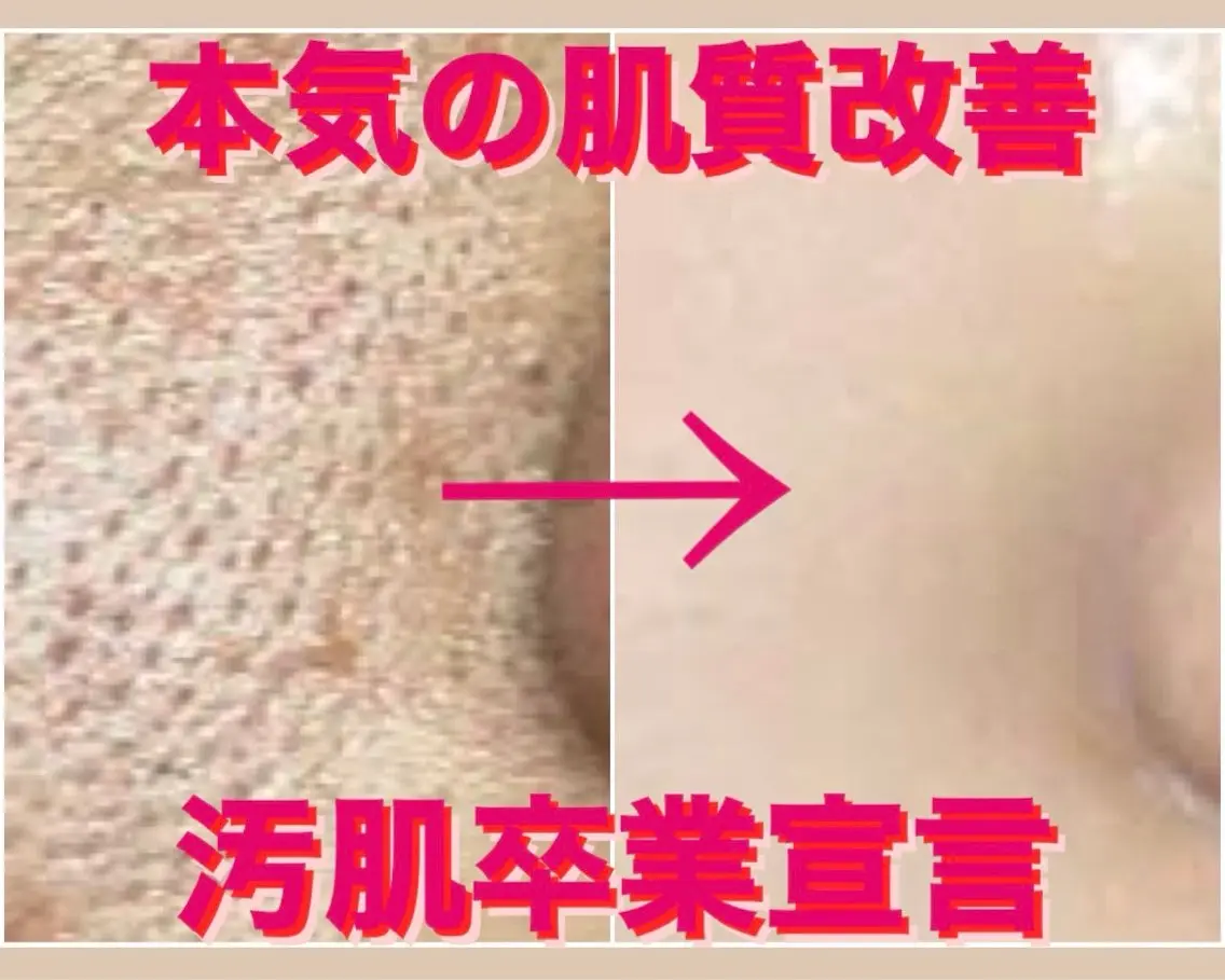 毛穴洗浄💆🏻‍♀️💧‬+ハーブピーリング🌿の写真