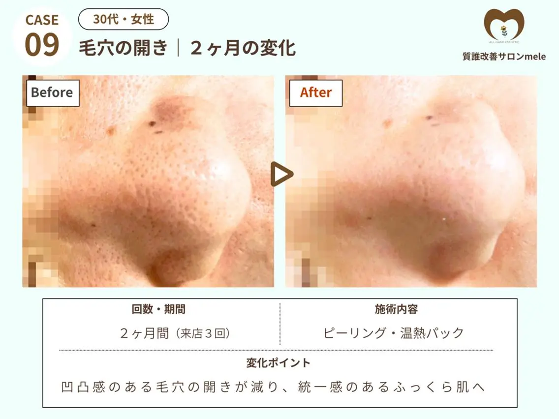 【9月中ご来店限定】 💆毛穴悩み専用💆黒ずみ・開き・ざらつきケア◎ 角質除去 +温熱パックの写真