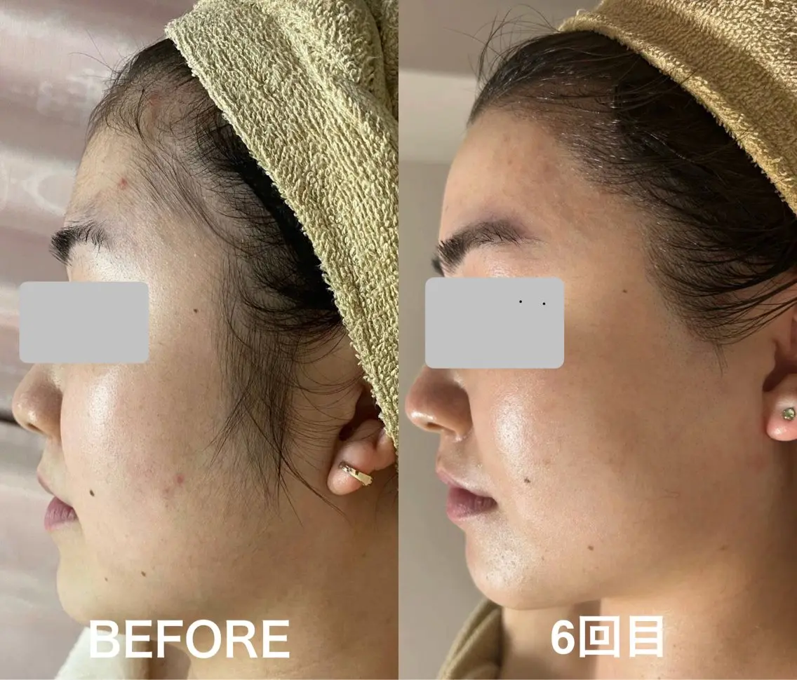 【すっぴんに自信が持てる◎トーンアップ◎】顔脱毛×シェービング付🪒¥4,900の写真