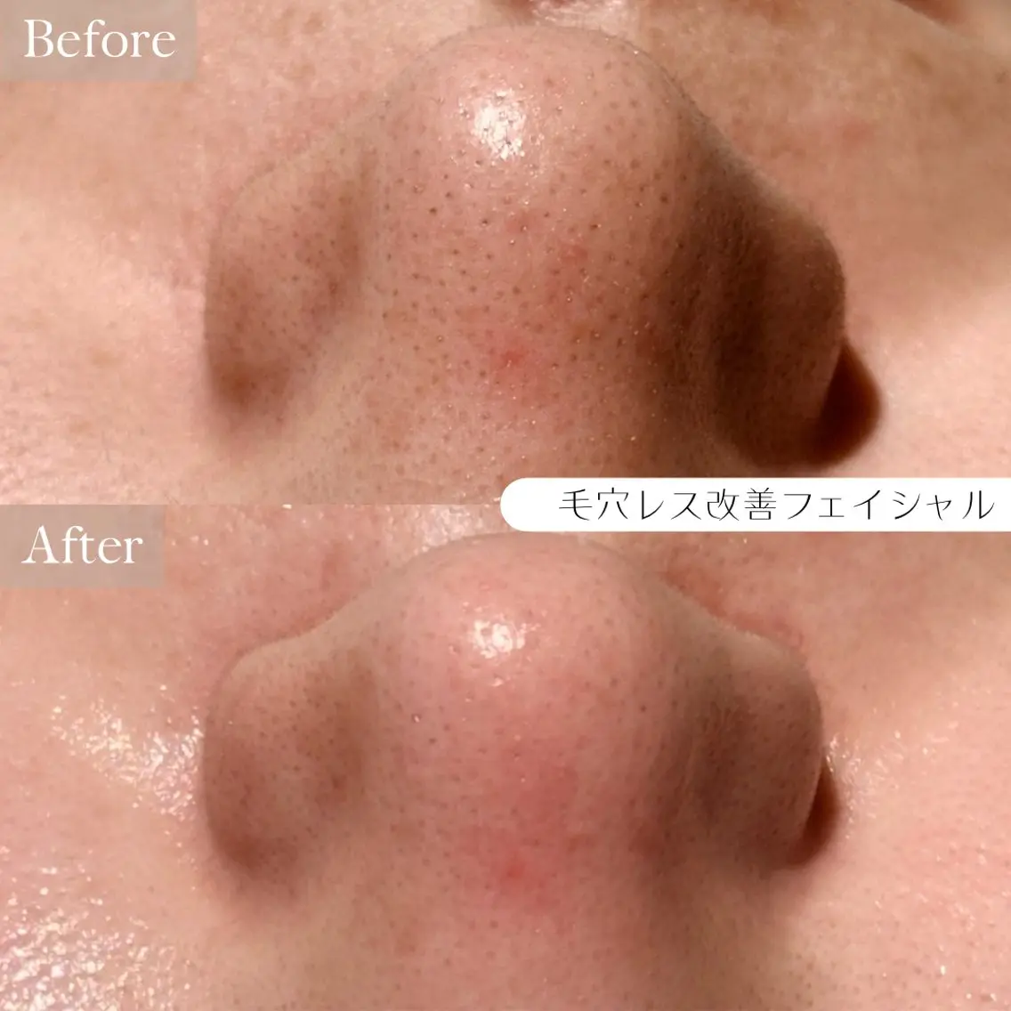 エステ ルコル池袋【毛穴洗浄 /wax顔脱毛】えみのエステ・リラクイメージ