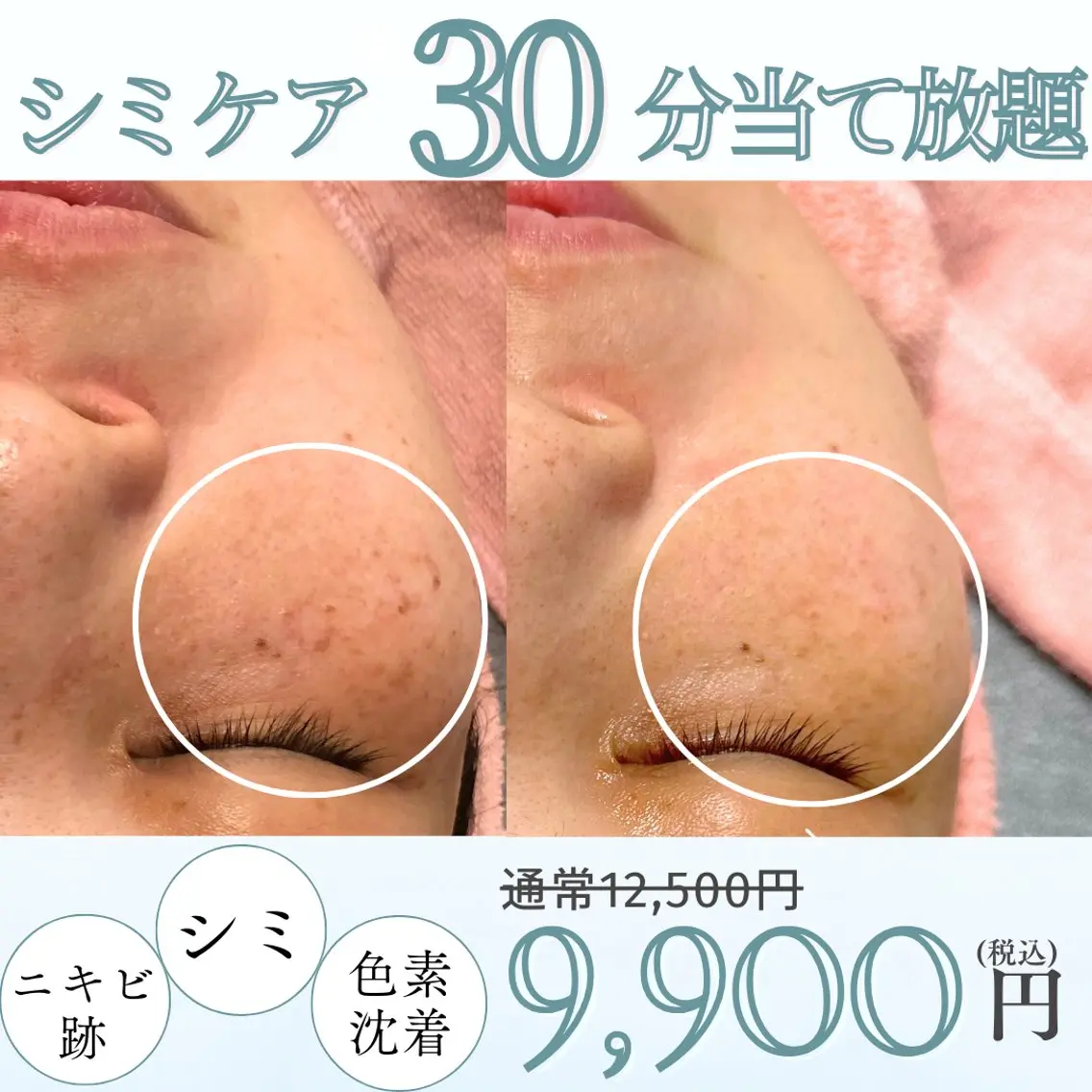 ✨シミ取り30分✨《シミケアプレミアムコース》美容液のエレクトロポレーション導入＋ヘッド・デコルテマッサージ付き！の写真