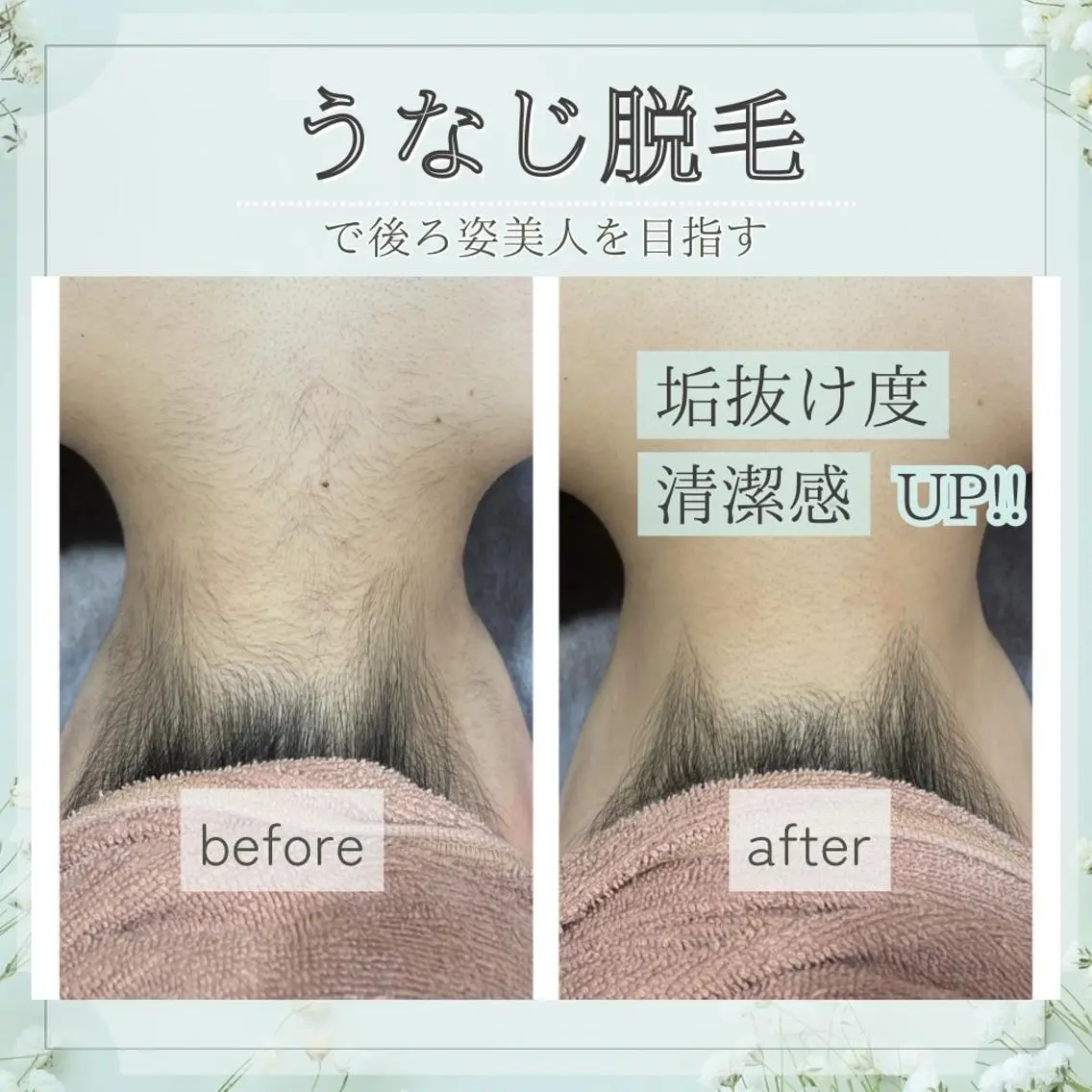 🌙学割U24限定🌙うなじで差がつく⭐ポツポツ毛穴は卒業！推し活/前撮り/成人式/イベント前準備の写真