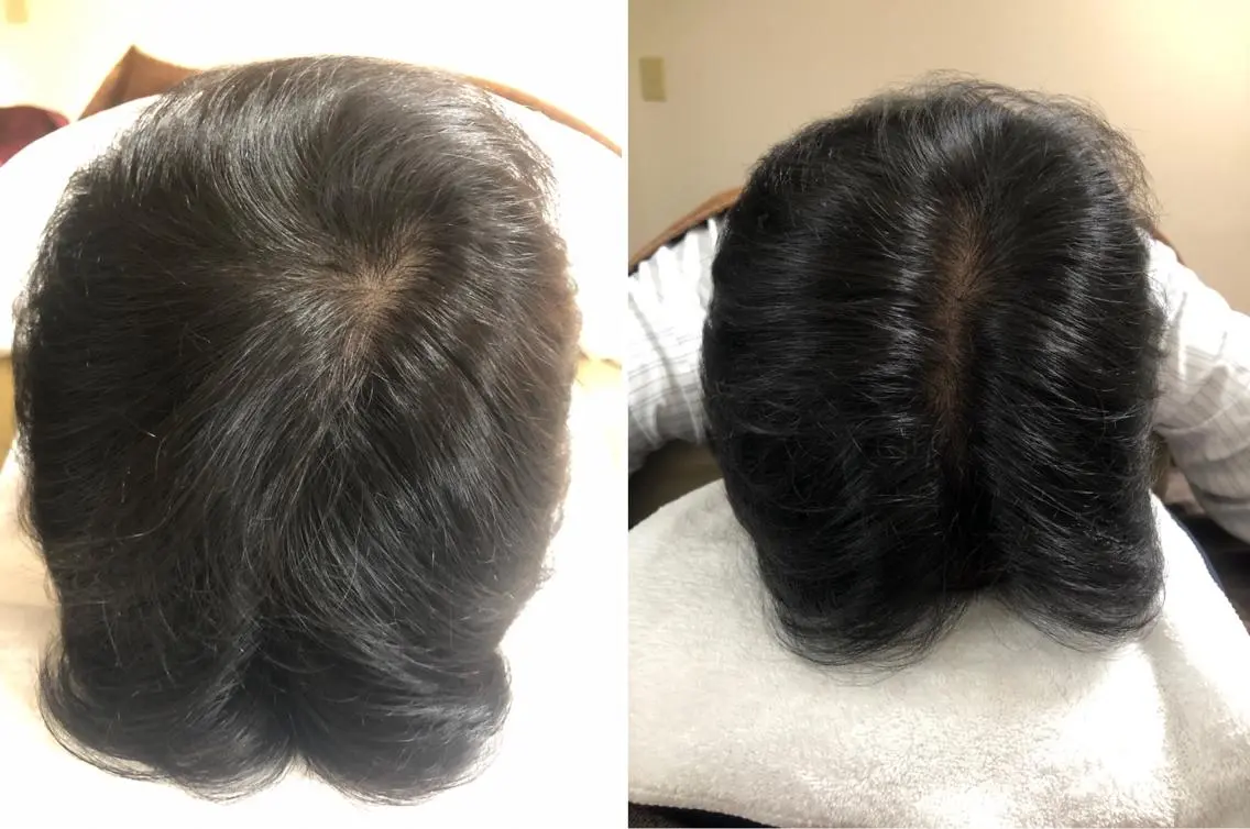 メンズ薄毛お悩み頭皮鍼【日中限定キャンペーン】✨特別価格1回のみ（2回目からもお得）優先予約枠確保の写真