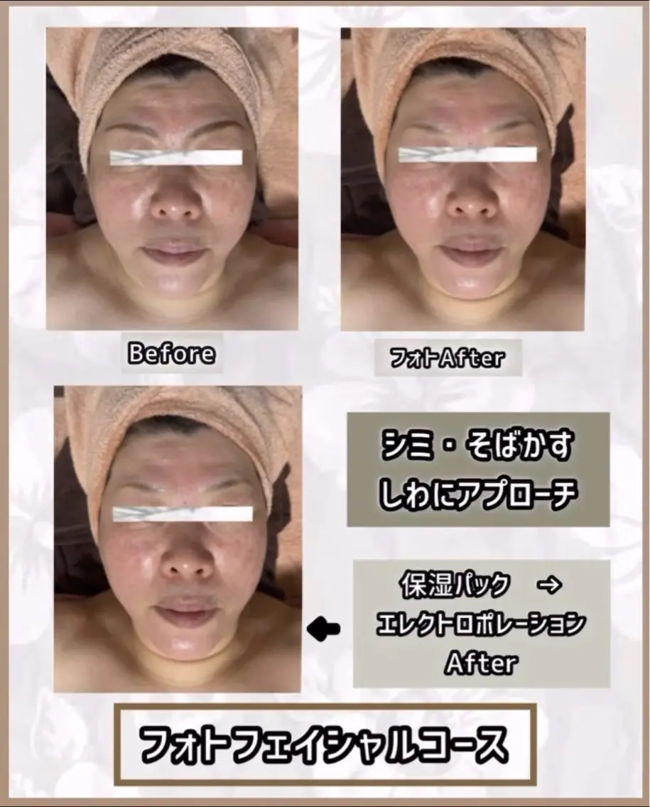 光フェイシャル　8,000円 →初回限定6,500円の写真