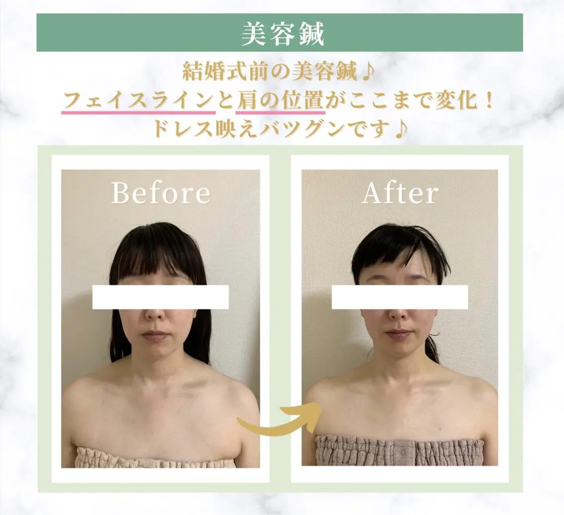 人気NO.1【プレミアム美容鍼】小顔は背中と首の施術で変わる❣️背中ラジオ波トリートメント+で小顔効果を更にUP⤴️の写真
