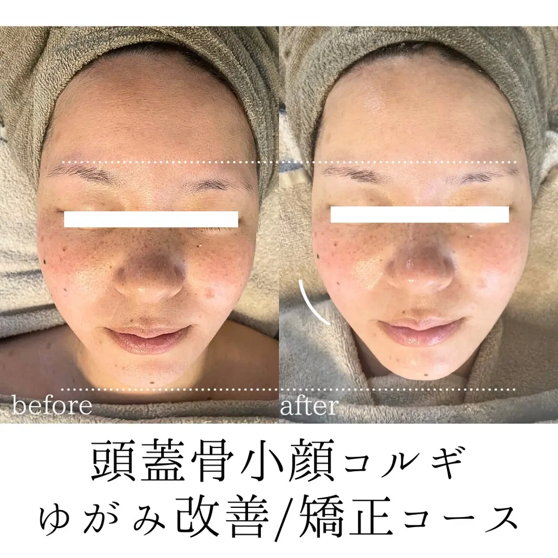 矯正コース【歪み/左右差改善】頭蓋骨小顔コルギ60分の写真