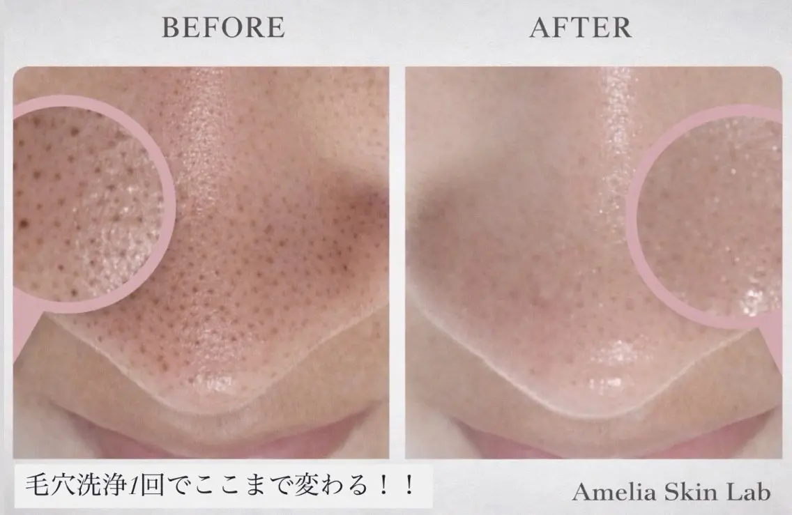 【5/17 15時​〜​限定半額】毛穴洗浄+艶肌Wax（全顔）+鎮静ケアの写真