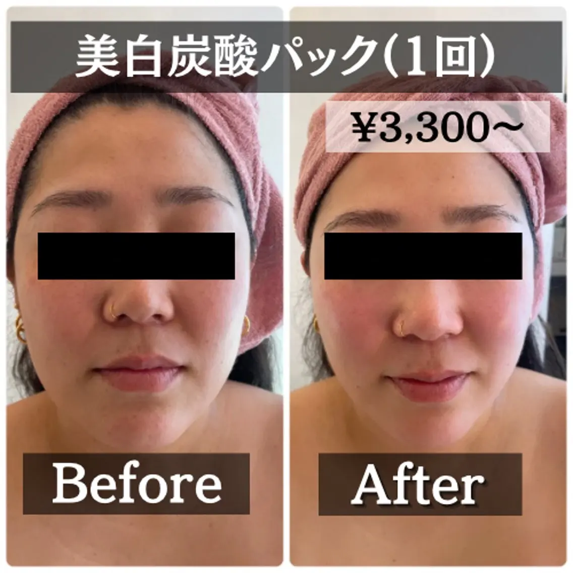 【ミニモ限定】くすみのないモチモチ肌に★炭酸美白パック​〜​ヘッドマッサージ付​〜​　¥5,280→¥3,300の写真