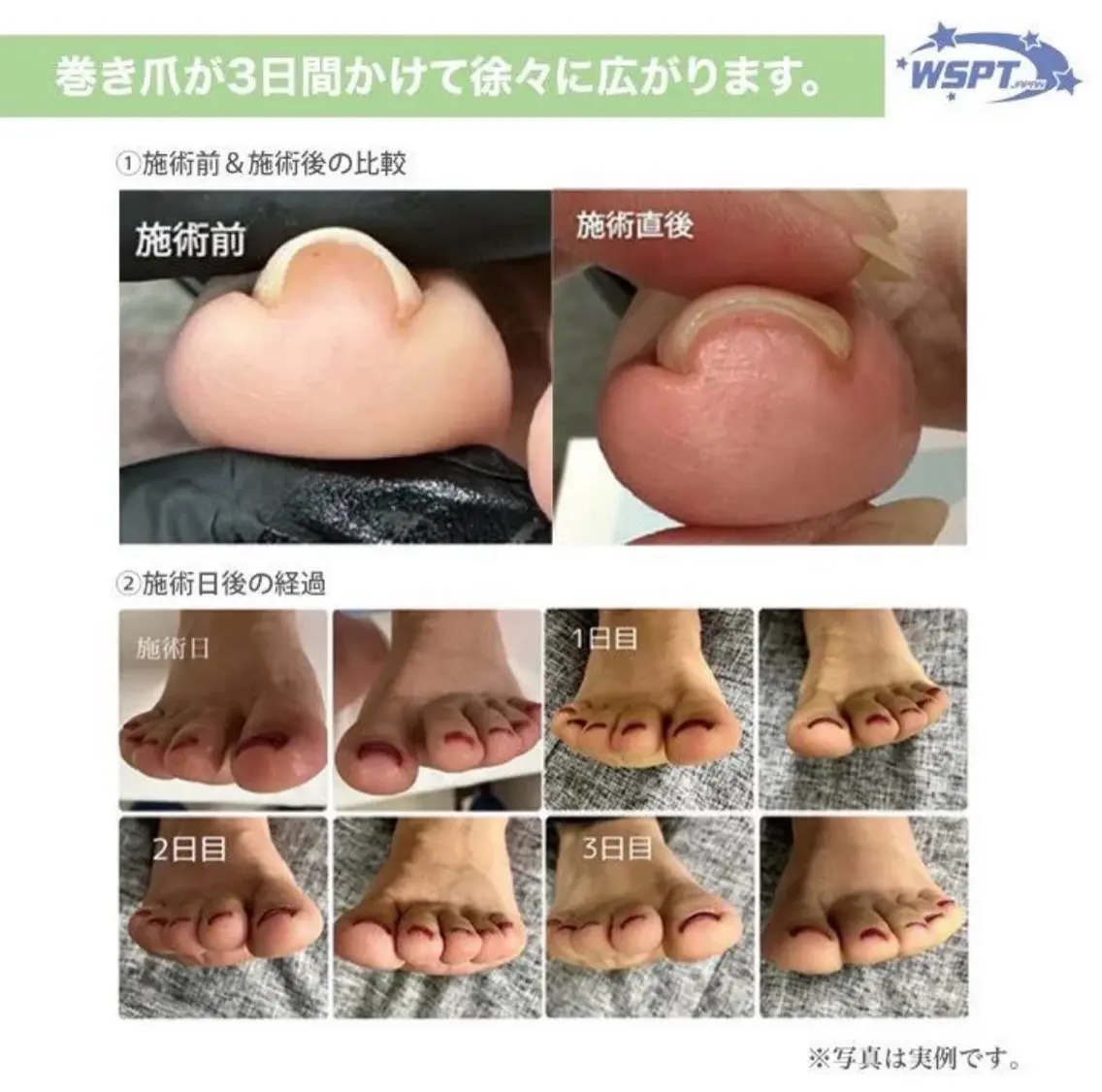 巻き爪ケアジェル(1本)※フットワンカラーの同時施術可能の写真